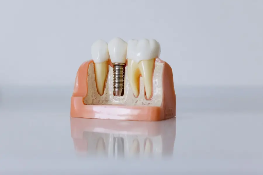 Implan Gigi — Saphire Dental & Beauty