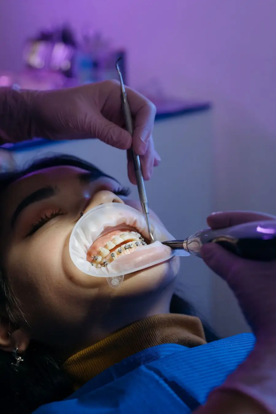 Perawatan Saluran Akar — Saphire Dental & Beauty